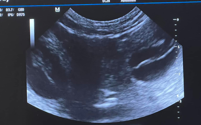 Dwyn is pregnant according to<br/>ultrasound